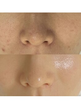 スーメ 柏(soome')の写真/韓国式の肌管理で、つるんとした陶器肌へ。毛穴の汚れをすっきり落として透明感UP＊[柏/フェイシャル]