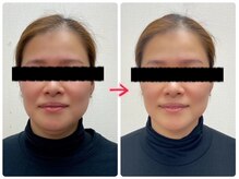 アーズ(A-Z)/1回でもスッキリ小顔実感！！