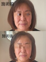 リオズ(RIO'S)/お客さん小顔を施術前後比べ写真