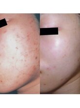 ホワイトアクア 姫路店(WHITE AQUA)/ララピール/姫路/美肌