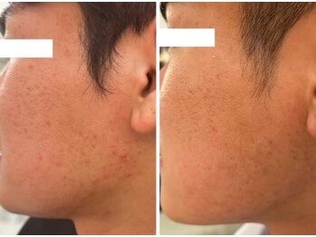 ホワイトアクア 四日市店(WHITE AQUA)/ニキビケア/四日市ハーブ