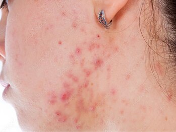 くつろぎ処癒家の写真/繰り返すニキビも徹底ケア！肌質に合わせて調合するハーブピーリング/IPSピール/プラズマが人気♪