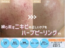 ムーロ バイ ミュー(muro. by mieux)の雰囲気（繰り返すニキビ/詰まり毛穴/黒ずみ毛穴を撃退！圧倒的ツヤ肌に！）