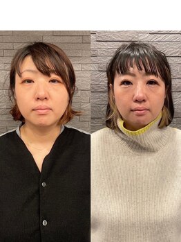 長寿鍼灸院 長寿整骨院/ハリネズミ女優美容鍼効果★