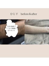 キッキー(Kicky)/剛毛でも痛み少なく脱毛できます