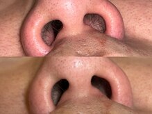 クラウン 心斎橋店(CROWN)/ノーズ(鼻毛)ワックス