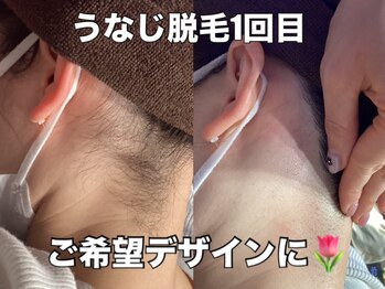 リエル(RIEL)/【うなじ脱毛】