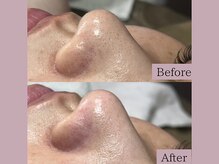 ティーツリー 名古屋 桜山(Tea Tree)/【毛穴ケア・毛穴洗浄】毛穴シミ