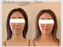 メラリノ(Melalino)/内臓整美1回の変化♪