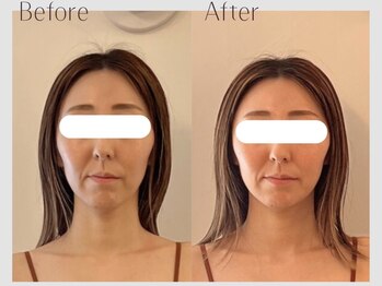 メラリノ(Melalino)/内臓整美1回の変化♪