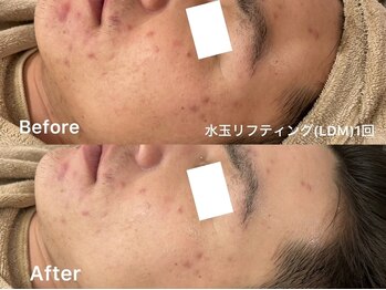 ヴェアリー 広尾(VARY)/ニキビケアのあと残りに。