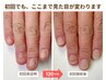 【人に見せられない深爪に】120分で見た目改善｜深爪矯正お試し体験