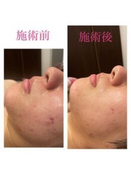 アイリス 川崎/【ハーブピーリング】症例