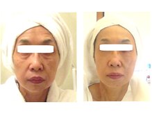 サロンドエステケイワイ(de KY)/フェイシャル☆小顔・タルミ改善