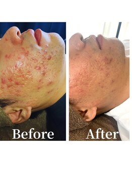 デン(DEN)/ニキビケア