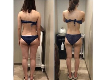 プロラボスパ 新宿店/20代後半 痩身症例