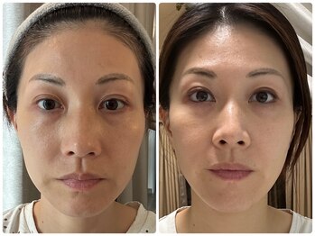 ラピスラズリ/水光プラセンタ注入【３回】