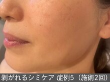 オアシスラグーン(OASIS LAGOON)/シミケア（症例5 施術2回）50代