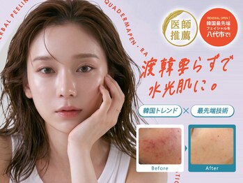 【韓国肌管理専門店】ハーブピーリング/ララピール/小顔矯正/毛穴洗浄　ソウルスキンの写真/【憧れの水光肌に◎】自己流では取り切れない黒ずみや角質！しっかりケアでふっくらハリ＆ちゅるん肌へ♪