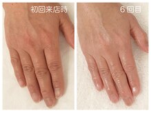 キレイテ 上野店/40代/6回目【上野ハンドケア】