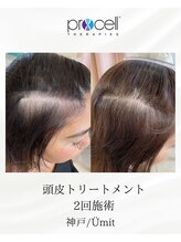 ユミト(Umit)/プロセルスカルプ