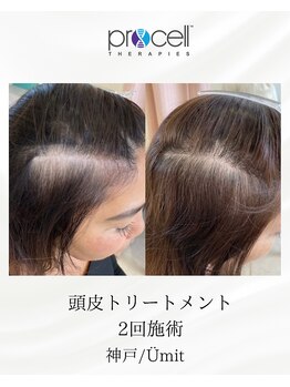 ユミト(Umit)/プロセルスカルプ