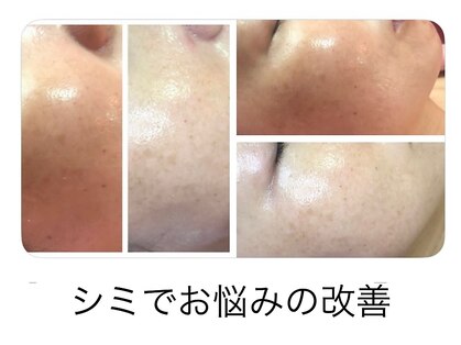トータルエステ ユキ(YUKI)の写真