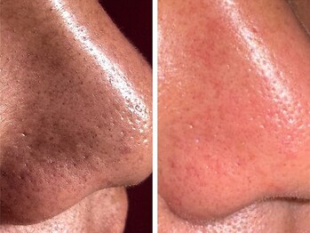 レネットサロン(Reinette Salon)/毛穴撲滅・毛穴ケア