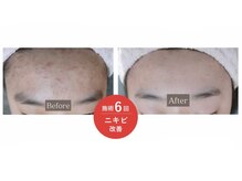 エン(O'en)/エクソソーム＋幹細胞導入☆