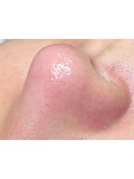 毛穴ケアをしたい