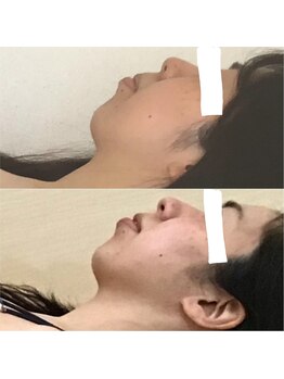 ユニック(unic)/小顔リンパ+カーボキシーケア1回