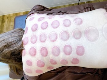 あんどら鍼灸接骨院/カッピング後