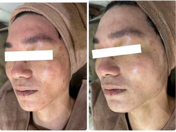 ホワイトアクア 四日市店(WHITE AQUA)/ニキビケア/四日市ハーブ