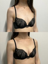 ジュリア(JULIA)/【バストアップ/育乳　症例】