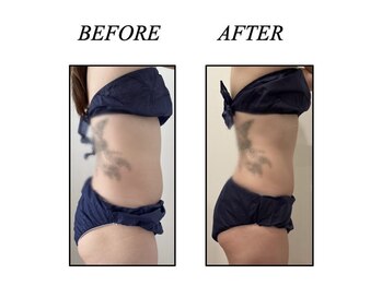 ファミーユ 新宿店/【インディバ　お腹ケア】