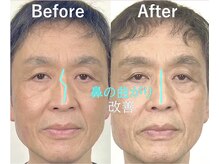 ラプリ 大宮店(Raplit)/隆鼻＋輪郭矯正40分10回