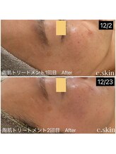 シースキン 盛岡駅前店(c.skin)/お客様ビフォーアフター♪