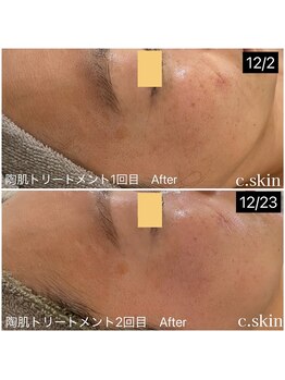 シースキン 盛岡駅前店(c.skin)/お客様ビフォーアフター♪