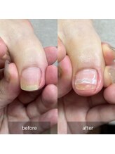 アイル(isle)/【巻き爪お悩み】違和感が…