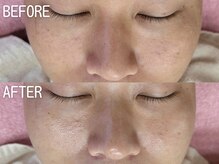 イエローウィーン(YELLOWEEN.)/ハーブピーリング