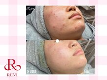 ラティーナ(Lattina)/陶肌トリートメント