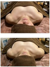 ルミエール(Lumiere)/【倉敷市】バストアップ施術事例