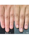 自爪育成3ヶ月コース