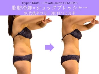 シャルム(charme)/脂肪冷却　3回目/1ヵ月半