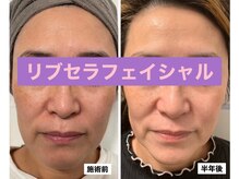 プリュネル(Prunelle)/プラズマシャワー