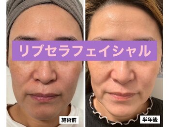 プリュネル(Prunelle)/プラズマシャワー