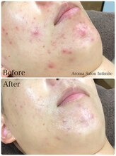 アンティミテ(Intimite)/パーソナルスキンケアコース