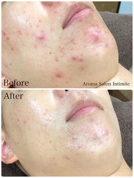 アンティミテ(Intimite)/パーソナルスキンケアコース