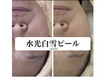 レピア(Le'pia)/水光白雪ピーリング