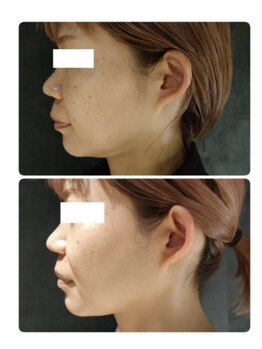 ソラ(sola*)/レモンボトル